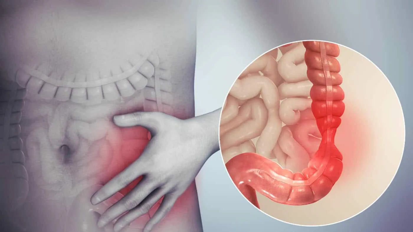 Hội chứng ruột kích thích là gì, gây ảnh hưởng như thế nào đến đường ruột.