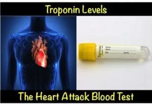 Troponin là sợi tơ cơ protein được tìm thấy trong cơ vân và cơ tim
