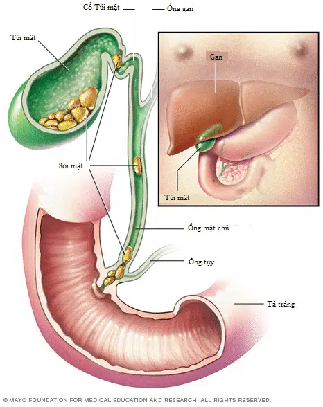 Sỏi mật gây tắc nghẽn ống tụy dẫn đến viêm tụy. Nguồn ảnh minh họa: Mayo Foudation