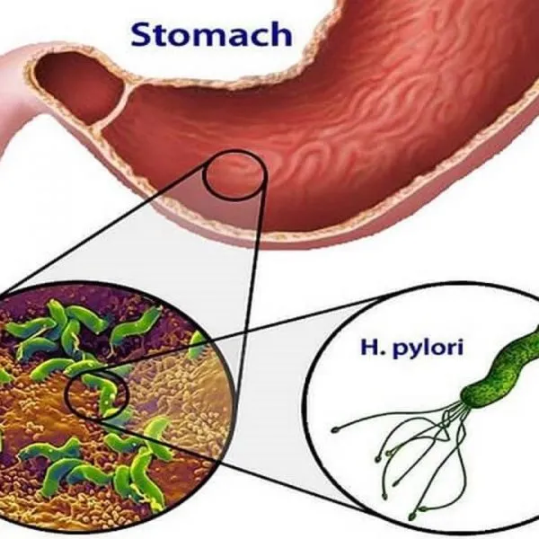 Vi khuẩn Hp (Helicobacter pylori) là nguyên nhân chính gây viêm loét và ung thư dạ dày. (Ảnh minh họa sưu tầm)
