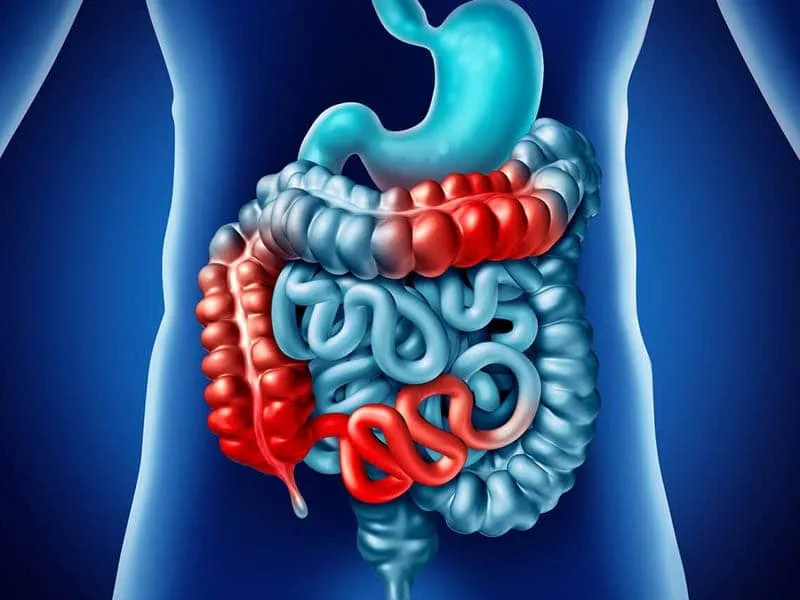 Các vị trí bệnh Crohn thường biểu hiện trong ống tiêu hóa. (Ảnh minh họa sưu tầm)