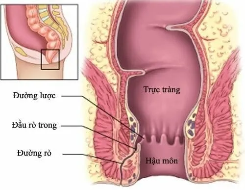 Bệnh Crohn trong giai đoạn 3 xuất hiện các đường rò quanh hậu môn. (Ảnh minh họa sưu tầm)