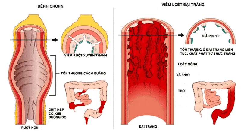 Ảnh minh họa giải phẫu lớp cắt ruột so sánh bệnh Crohn và viêm loét đại tràng. (Ảnh minh họa sưu tầm)
