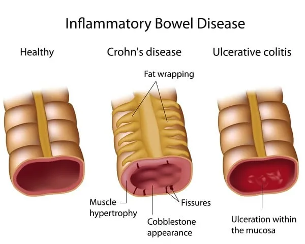Bệnh Crohn có thể ảnh hưởng đến tất cả các lớp thành ruột, gây viêm dạng lát đá và xuất hiện các đường rò. (Ảnh minh họa sưu tầm)