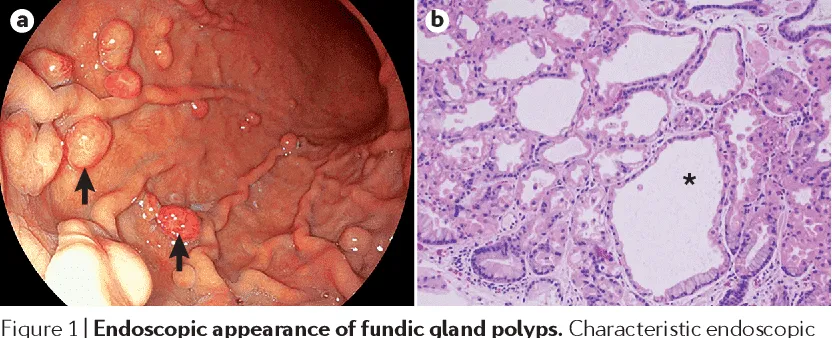 Hình ảnh nội soi và tế bào polyp tuyến đáy vị dạ dày. Nguồn: sưu tầm National Library of Medicine