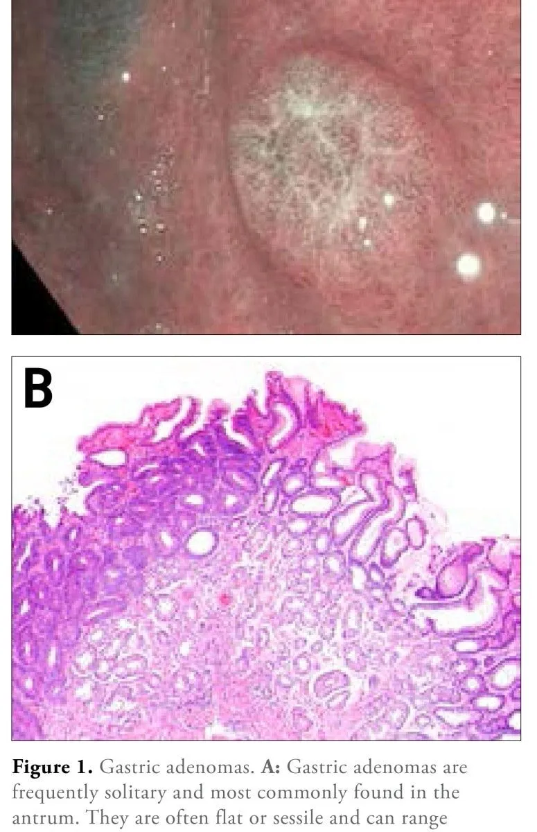 Hình ảnh nội soi và tế bào polyp tuyến dạ dày. Nguồn: sưu tầm PubMed Central