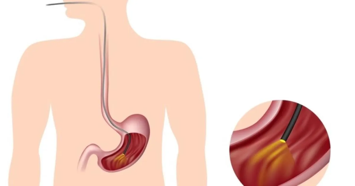  Nội soi thực quản - dạ dày - tá tràng là phương pháp chính xác nhất để chẩn đoán polyp dạ dày. (Ảnh minh họa sưu tầm)