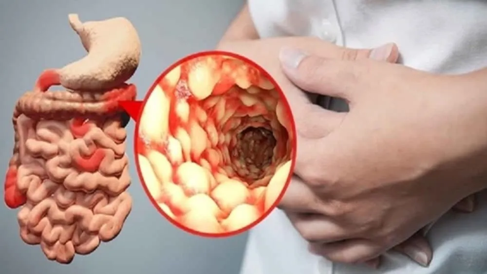Bệnh Crohn có thể dẫn đến biến chứng ung thư tá tràng. 