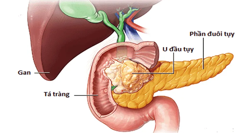 Phẫu thuật cắt khối tá tụy để loại bỏ khối u lành tính di căn đến tụy và u biểu mô đệm ở ống tiêu hóa trong điều trị ung thư tá tràng. 