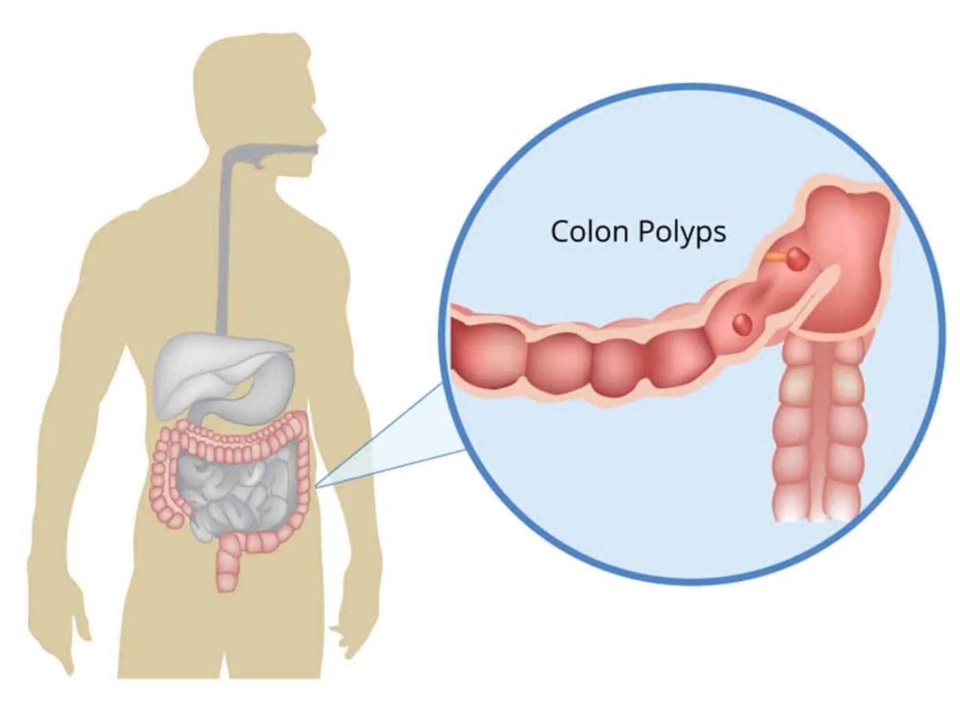 Yếu tố nguy cơ và nguyên nhân gây polyp đại tràng? hút thuốc tăng nguy cơ bệnh polyp đại tràng