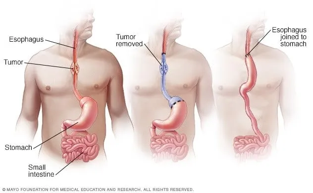 Ảnh minh họa phương pháp cắt bỏ một phần thực quản và tạo hình ống dạ dày thay thế thực quản để loại bỏ khối u. Nguồn: Mayo Clinic