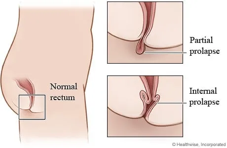 Ảnh minh họa so sánh tình trạng trực tràng bình thường (normal rectum) với sa niêm mạc (partical prolapse) và sa bên trong (internal prolapse). Nguồn: My Health Alberta - Government of Alberta.