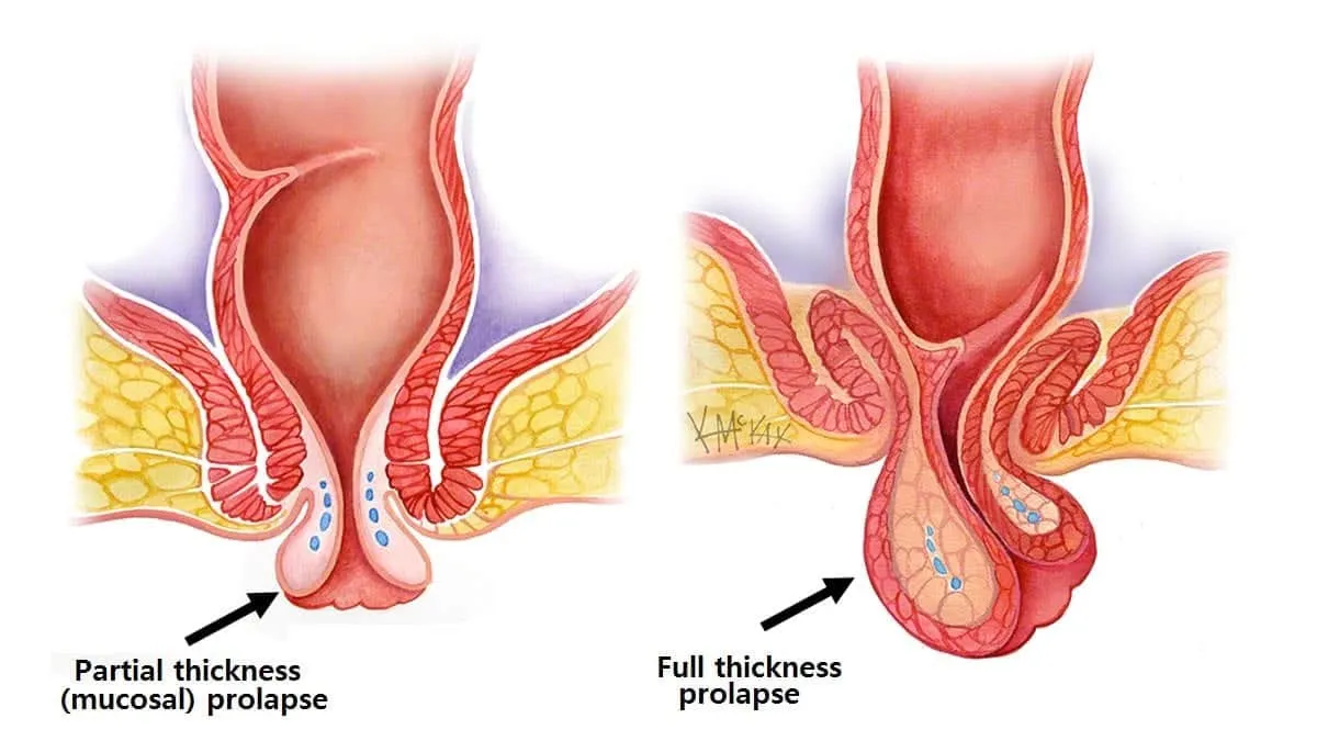 Ảnh minh họa so sánh tình trạng sa niêm mạc trực tràng (mucosal prolapse) và sa toàn bộ (full thickness prolapse). 