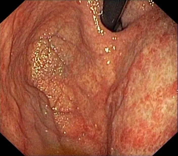 Hình ảnh nội soi niêm mạc dạ dày teo ở phình vị. Nguồn: sưu tầm MSD Manual