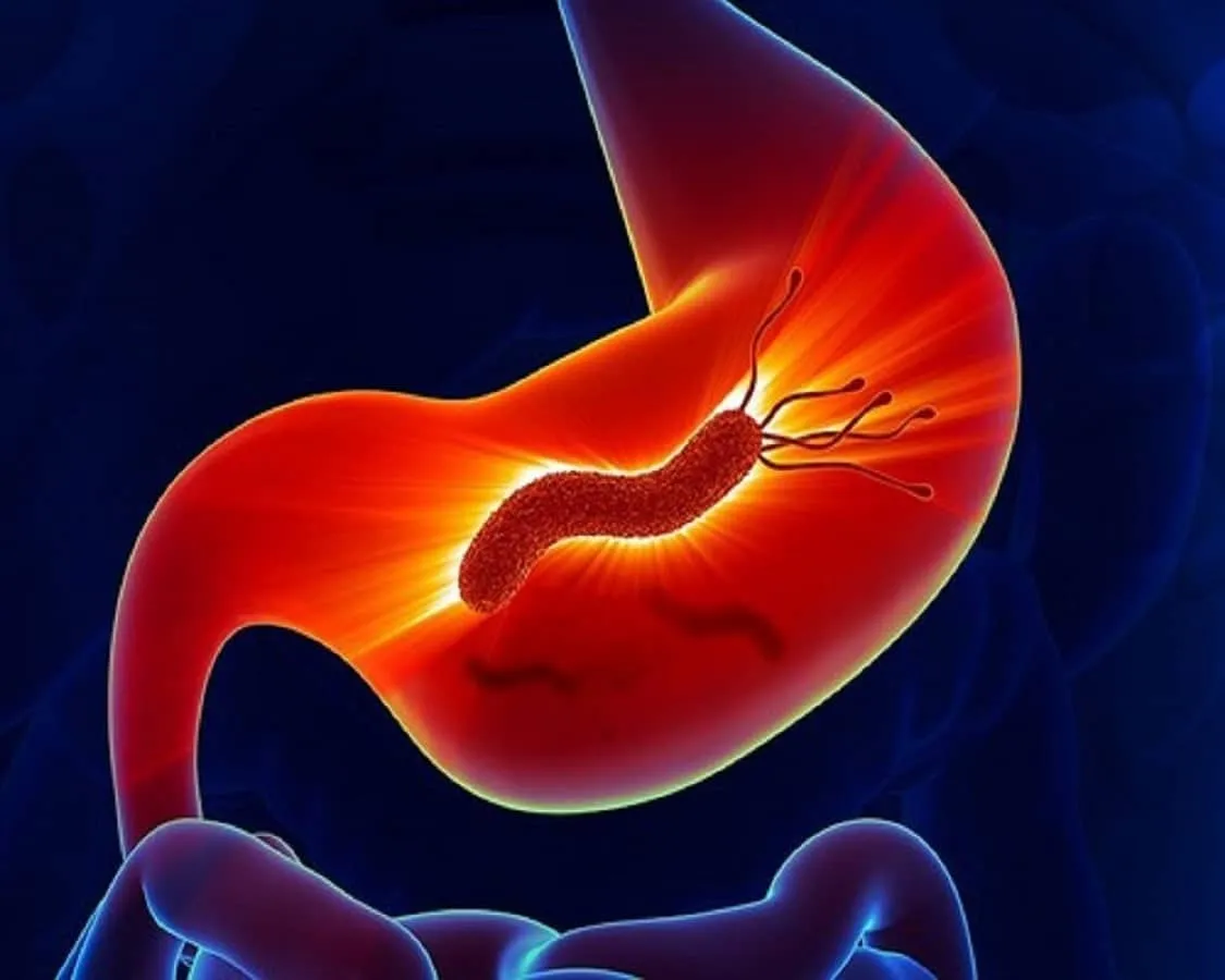 Nhiễm vi khuẩn Hp là nguyên nhân chính gây viêm dạ dày mạn tính, dẫn đến viêm teo niêm mạc dạ dày. (Ảnh minh họa sưu tầm)
