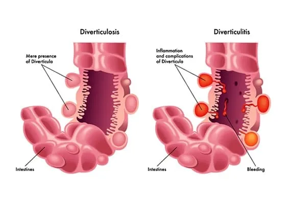 Viêm túi thừa (diverticulitis) là tình trạng viêm có thể bao gồm nhiễm trùng các túi thừa thường xuất hiện ở đại - trực tràng. (Ảnh minh họa sưu tầm)