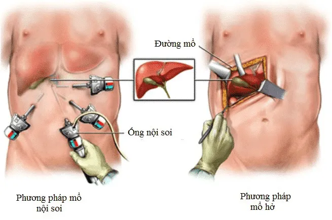 Điều trị sỏi mật ở hầu hết bệnh nhân có triệu chứng là phẫu thuật cắt bỏ túi mật. (Ảnh minh họa sưu tầm)