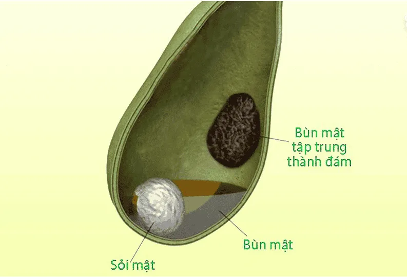 Sự kết hợp các tinh thể trong bùn mật và chất nhầy của màng túi mật trong thời gian kéo dài chính là điều kiện thuận lợi để tạo sỏi cholesterol trong túi mật. (Ảnh minh họa sưu tầm)