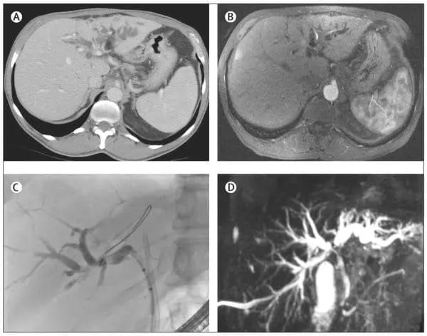 Hình chụp của bệnh nhân ung thư đường mật quanh ống gan trái. Phim chụp CT (A), MRI (B), chụp đường mật nội soi ngược dòng (C) và chụp đường mật cộng hưởng từ (D). Nguồn: sưu tầm NCBI