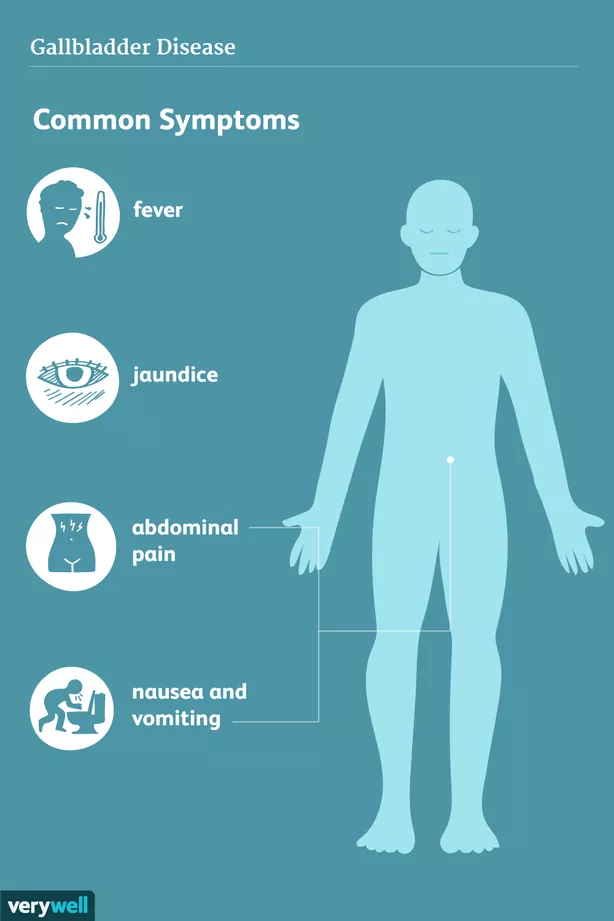 Sốt, vàng mắt và da, đau bụng và buồn nôn là các triệu chứng thường gặp nhất khi mắc các bệnh liên quan đến túi mật. Nguồn ảnh minh họa verywellhealth.com