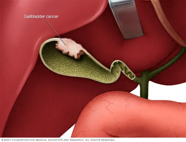 Ung thư túi mật là sự phát triển bất thường, không kiểm soát của các tế bào tại túi mật. Nguồn hình ảnh Mayo Clinic 