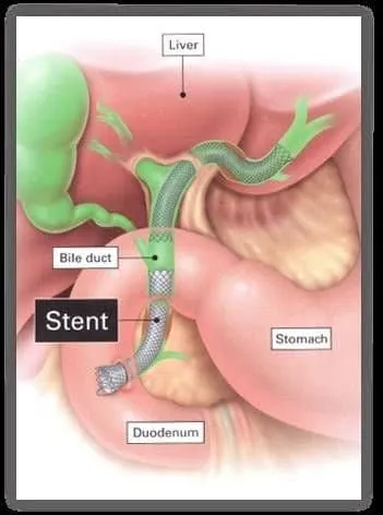 Đặt stent thông qua nội soi mật tụy ngược dòng (ERCP) để điều trị hẹp, tắc nghẽn đường mật. (Ảnh minh họa sưu tầm)