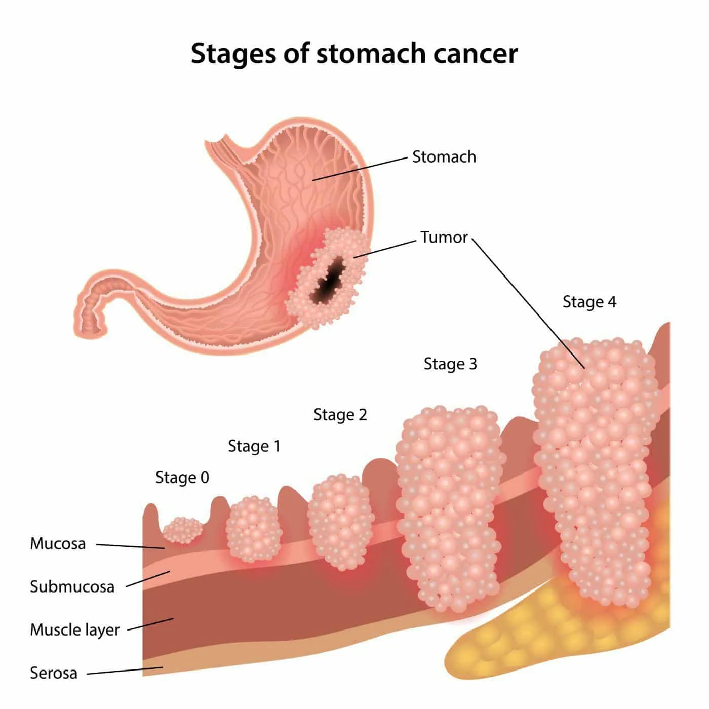 Khám và tầm soát ung thư dạ dày, diễn biến ung thư qua các giai đoạn
