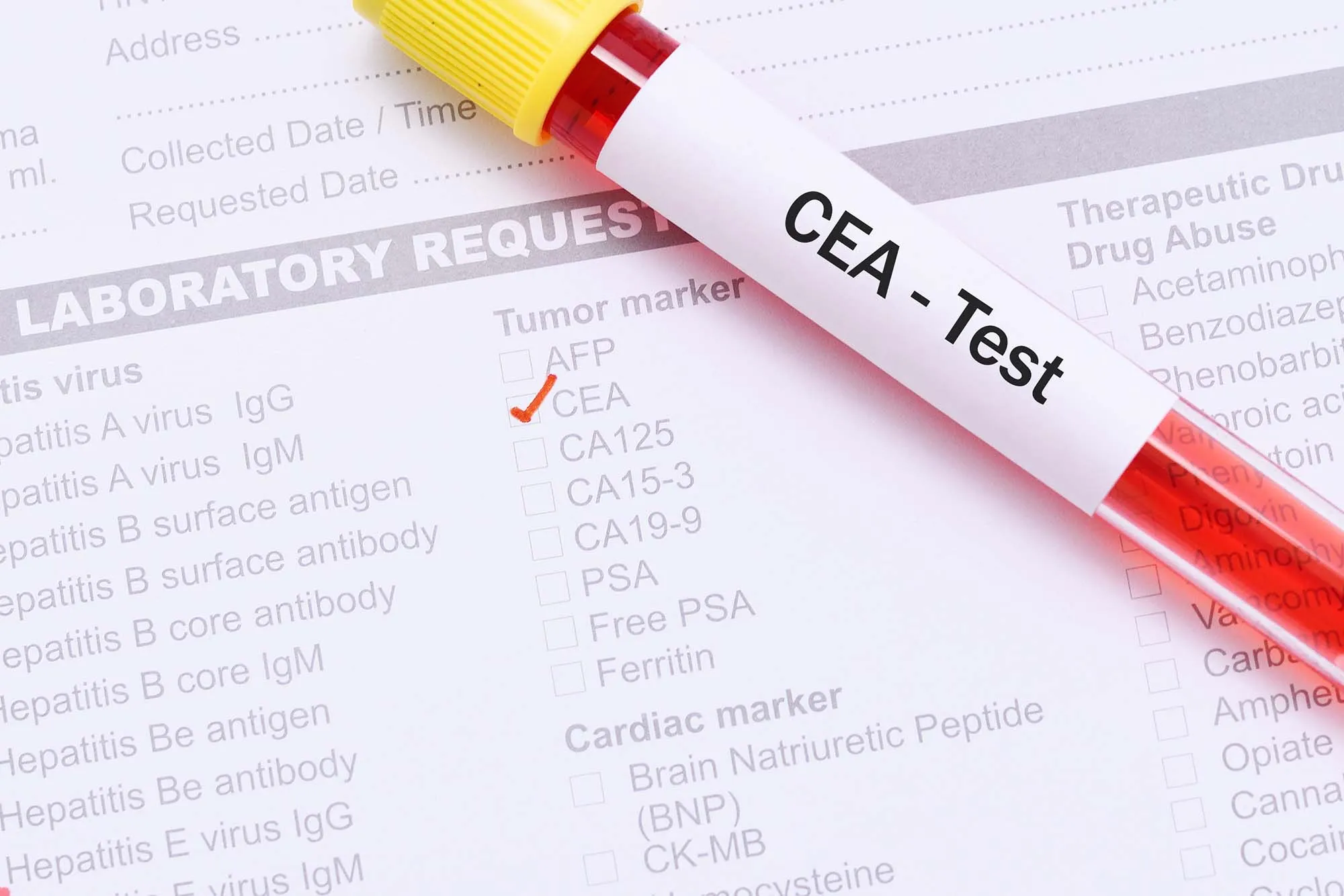 Cách đọc kết quả xét nghiệm dấu ấn ung thư CEA