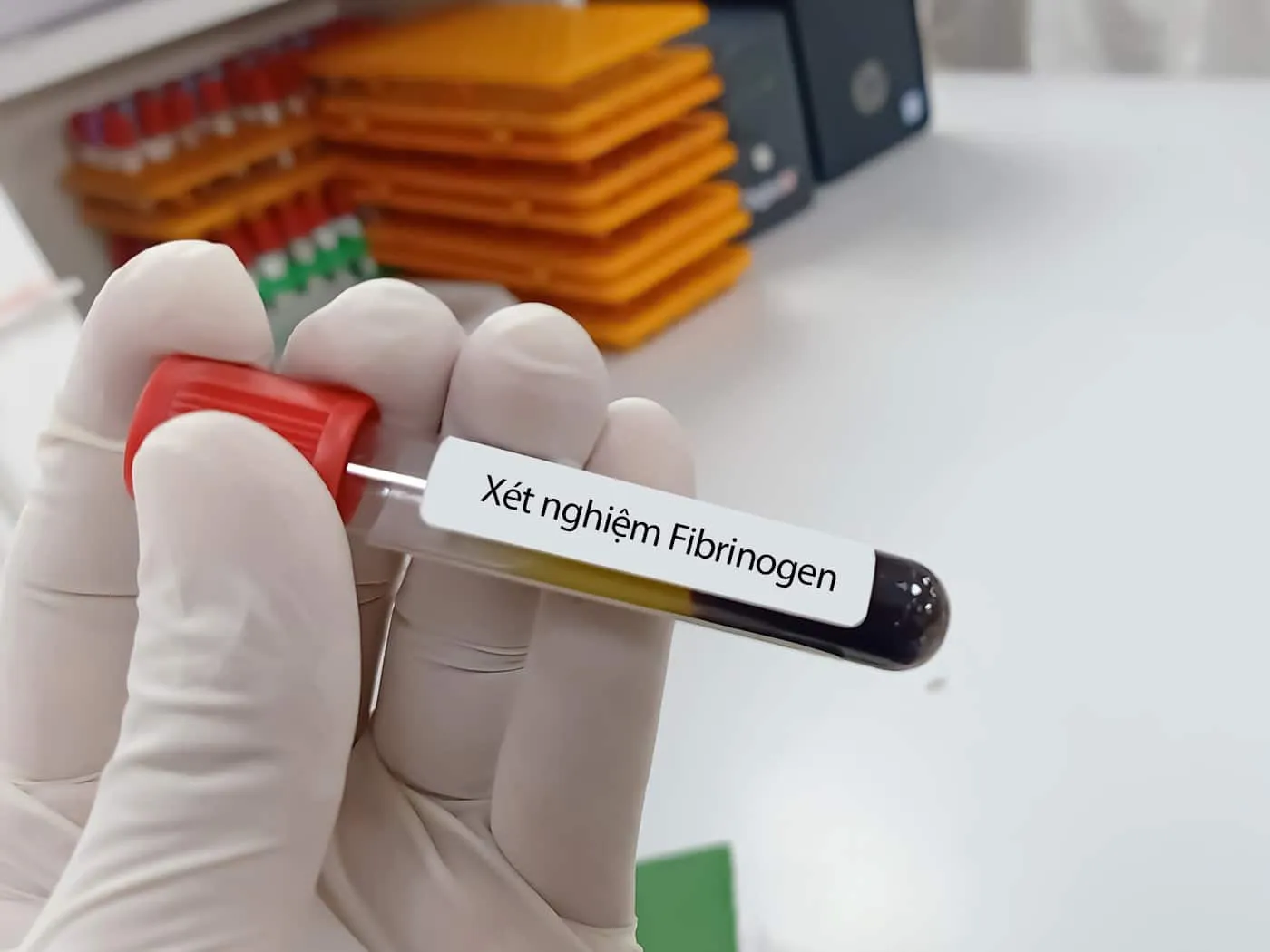 Chỉ số fibrinogen trong máu bao nhiêu là bình thường? Mẫu xét nghiệm fibrinogen máu