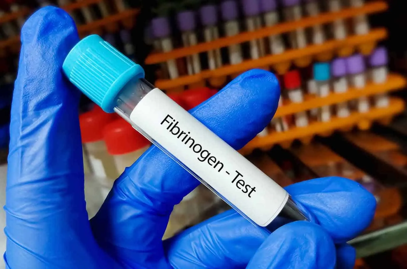 Fibrinogen là gì, Chỉ số fibrinogen bình thường là bao nhiêu?