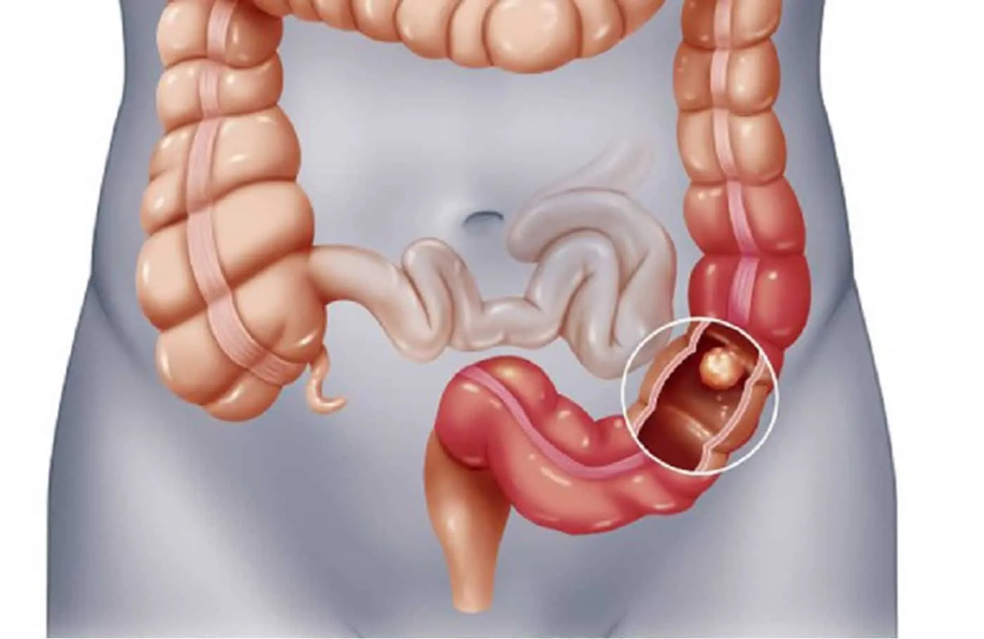 triệu chứng đau bụng âm ỉ kéo dài có thể biến chứng ung thư dạ dày