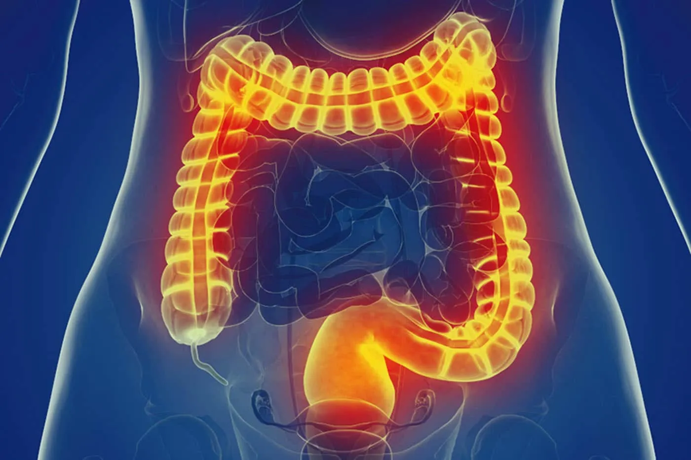 Nguyên nhân gây đau bụng bên trái - đau bụng trái do hội chứng ruột kích thích (IBS)