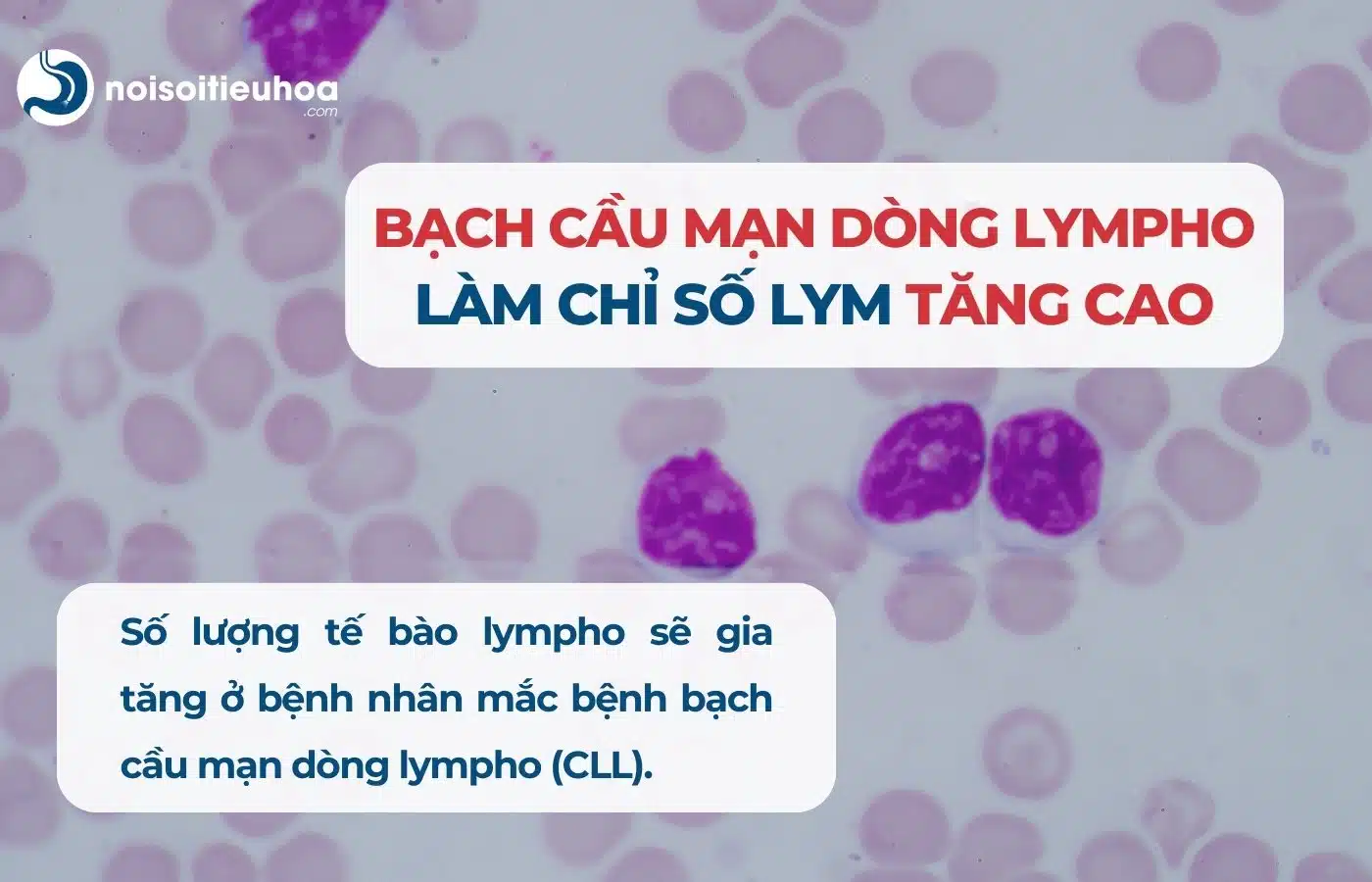 Bạch cầu mạn dòng lympho (CLL) làm chỉ số LYM tăng cao