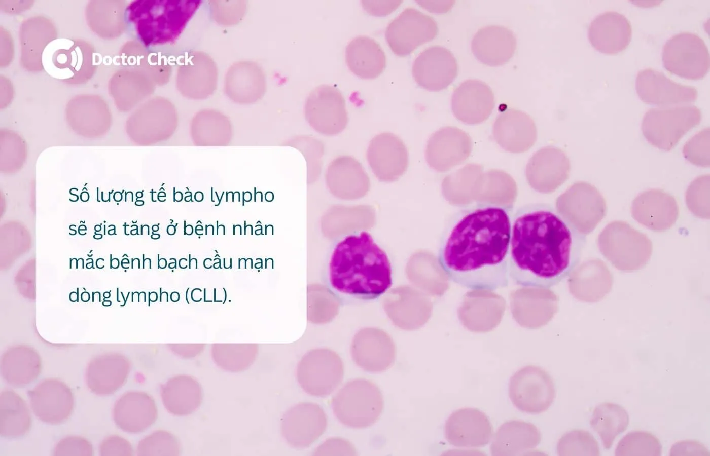 Số lượng tế bào lympho tăng ở bệnh nhân CLL