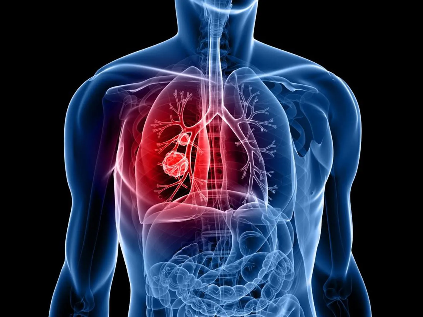 Ho khan kéo dài là một dấu hiệu của ung thư phổi