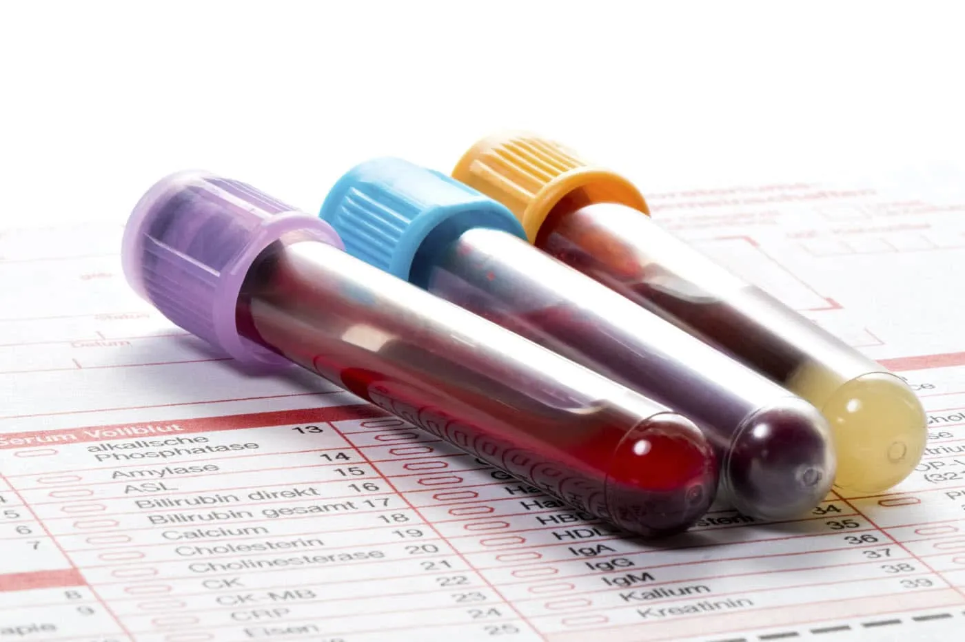 xét nghiệm máu là một trong những xét nghiệm ung thư đại tràng đúng không?