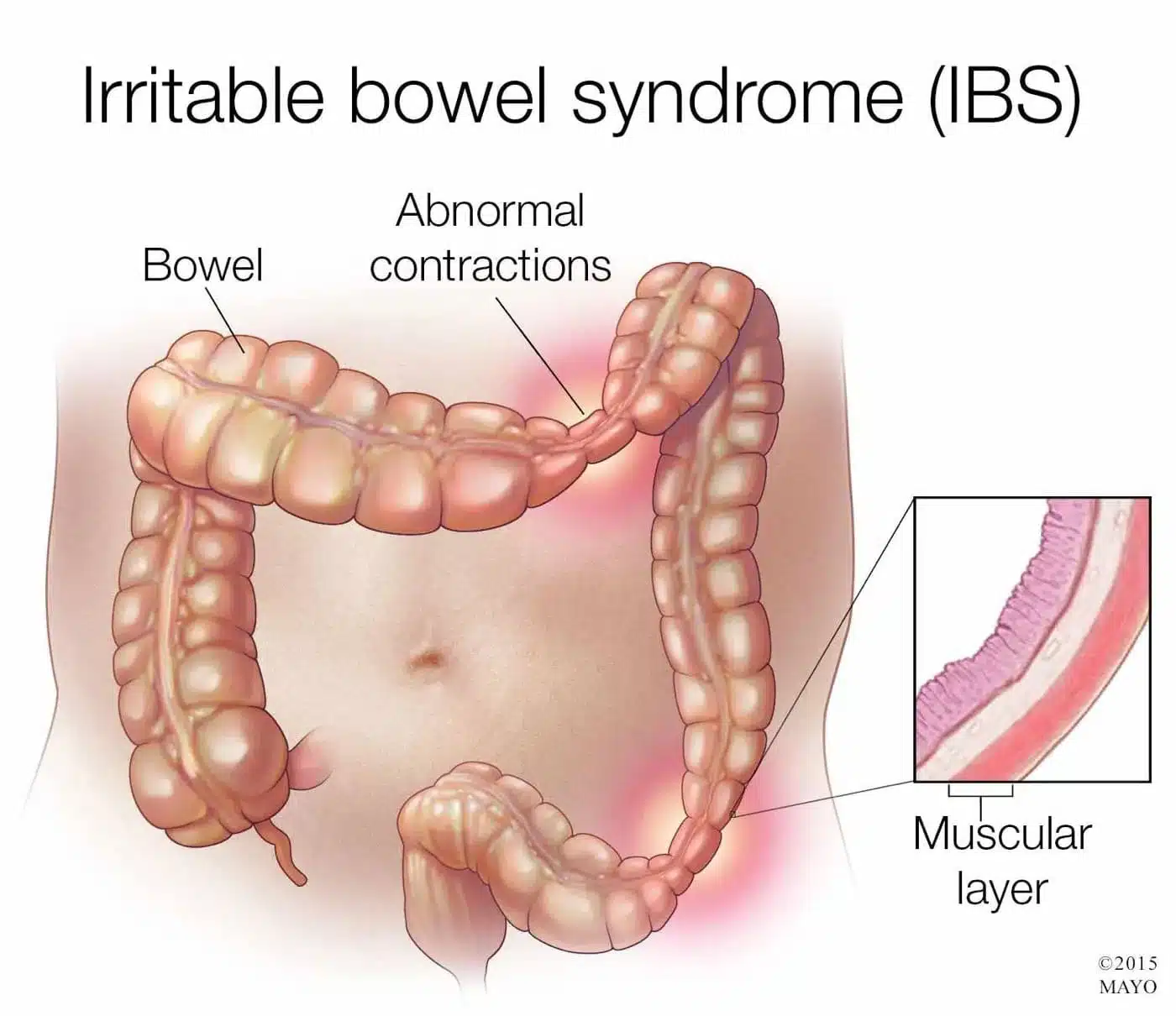 Hội chứng ruột kích thích (IBS) nguyên nhân gây ăn xong bị đau bụng đi ngoài