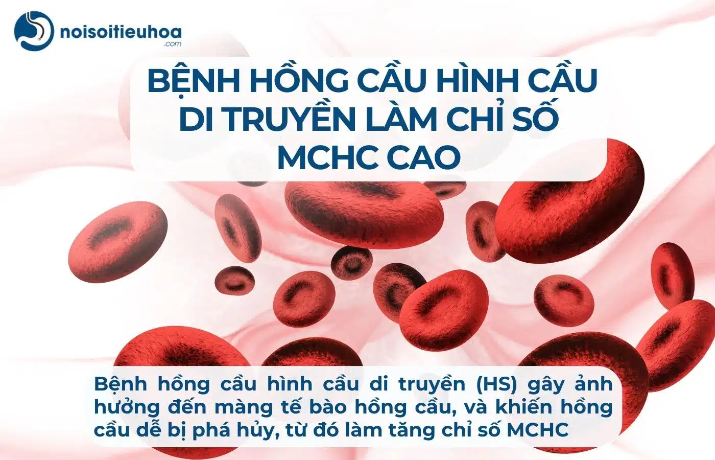 Bệnh hồng cầu hình cầu di truyền (HS) làm chỉ số MCHC tăng cao