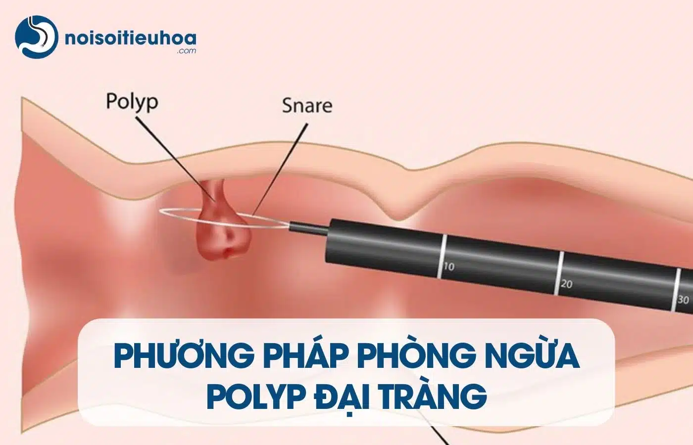 Phương pháp phòng ngừa polyp đại tràng